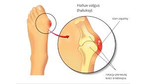halluxes