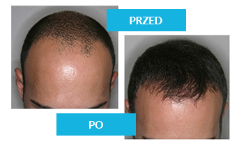 Prolesan Pure
