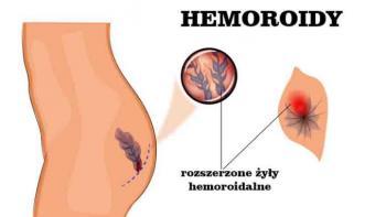 Hemorroides